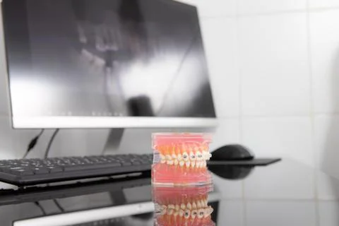 Panoramic x-ray on computer screen. Model of the jaw on the table Stock Photos