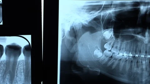 Panoramic X-ray of human jaw with braces at dentist office Stock Footage 88192565