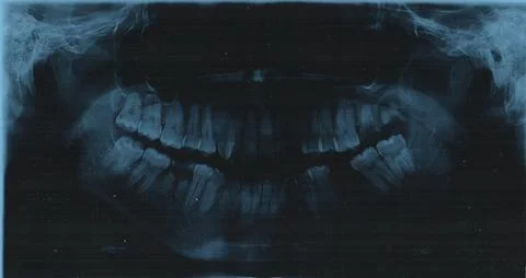 Panoramic x-ray image of the teeth Fotos de archivo