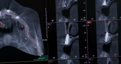 Panoramic x-ray of the jaw on a computer screen Stock Footage 233258336