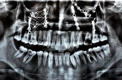 Panoramic X Ray shows multiple plates, screws for maxillary fixation of a f.. Stock Photos