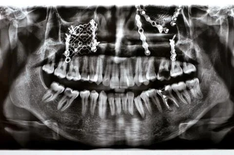 Panoramic X Ray shows multiple plates, screws for maxillary fixation of a f.. Stock Photos