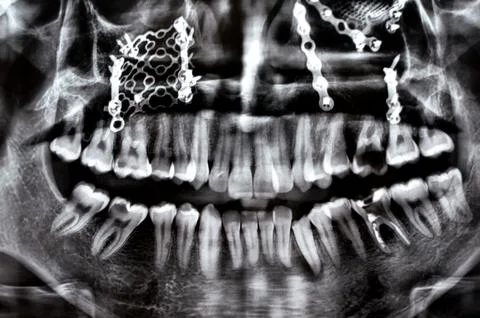 Panoramic X Ray shows multiple plates, screws for maxillary fixation of a f.. Foto stock