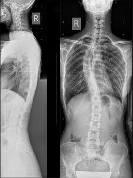 Panoramic x-ray of the spine in two projections. Stock Photos