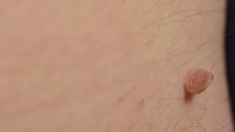 Papilloma on the body Stock Footage 78052927