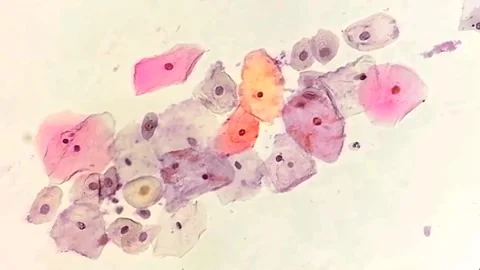 Paps smear: HPV related changes. Cervical cancer. SCC Video stock 273955269