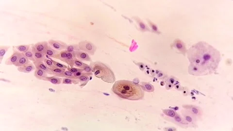 Paps smear: HPV related changes. Cervical cancer. SCC Video stock 273955270