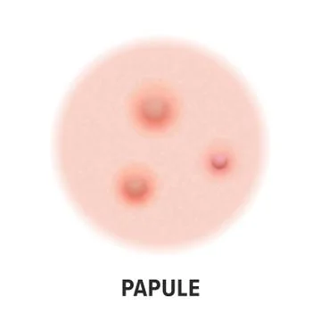 Papule skin acne type vector icon. Skin disease acne papule pimples type and  Stock-Illustration