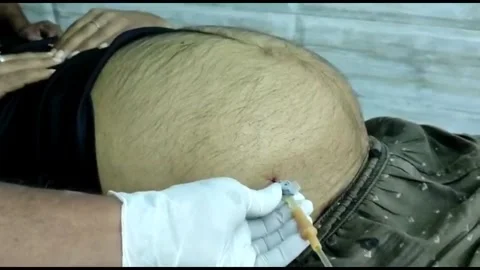 Paracentasis a medical process to remove fluid  from  abdomen. Stock Footage 220447790