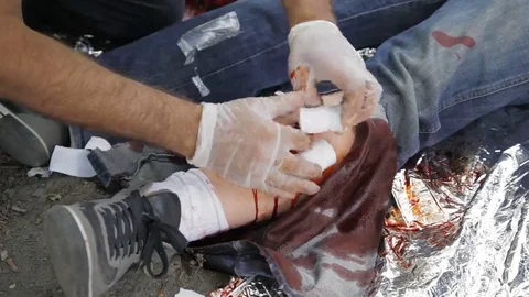 Paramedic dressing broken leg with open fracture Stock Footage 69125451