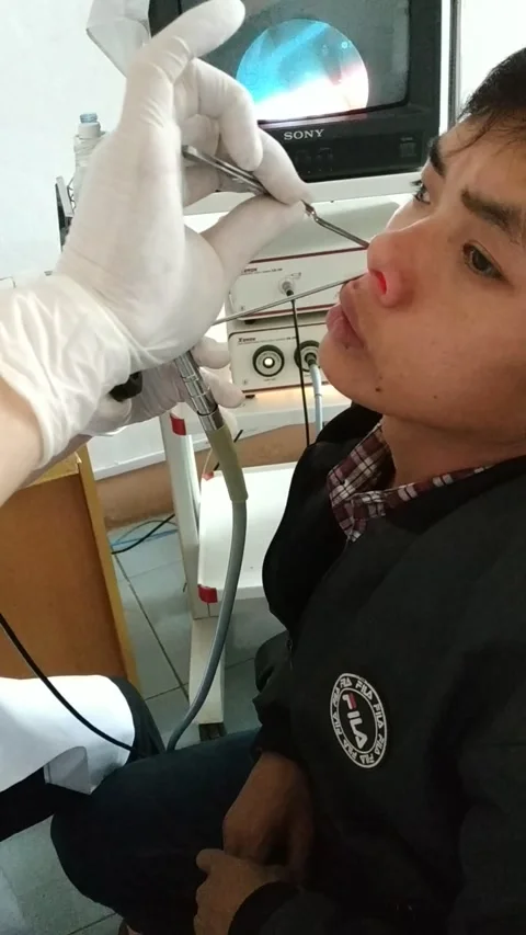 Parasite Pulled from Man's Nose, Lao Cai, Vietnam - 09 Apr 2019 Vídeos de archivo 205223498