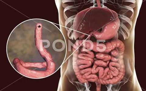 Parasitic hookworm Ancylosoma duodenale in human duodenum Stock Illustration