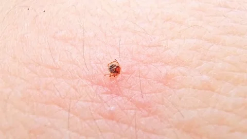 Parasitic tick biting human skin causing lyme disease Vidéo 335544710