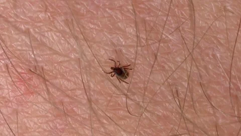 Parasitic Tick Crawling on Human Skin Searching for Feeding Spot Stock Footage 306233071