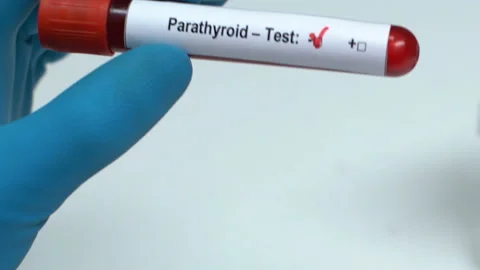 Parathyroid, doctor holding blood sample in tube close-up, health check-up Stock Footage 103651663