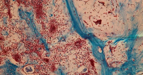 Parotid tumor tissue Vídeo Stock 144925724