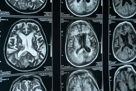 Part of a close-up MRI image of the brain. Diagnosis and treatment of brain Stock Photos