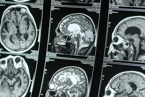 Part of a close-up MRI image of the brain. Diagnosis and treatment of brain Stock Photos