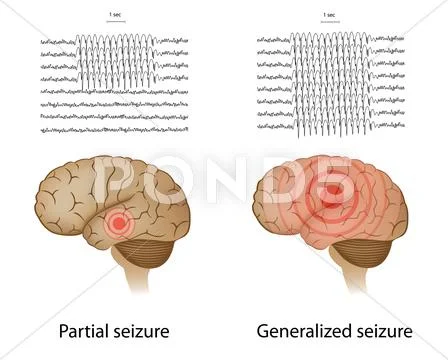 Partial and generalized epilepsy Stock Illustration