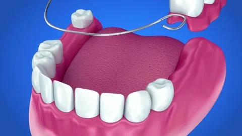 Partial Denture Fitting: Dental Prosthetic with Wire Clasp Stock Footage 327666480