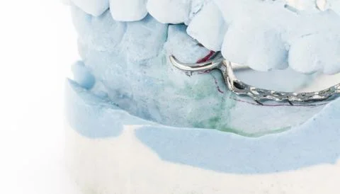 Partial denture on a plaster mold Stock-Fotos