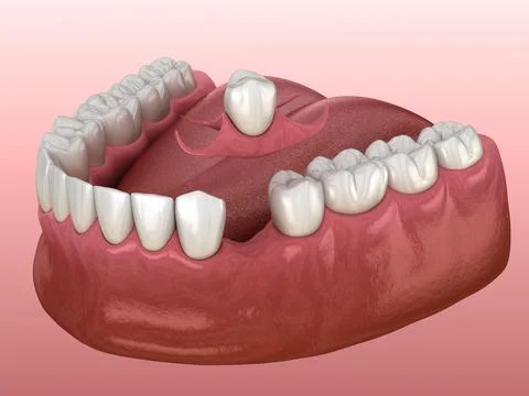 Partial removable immediate-denture type Butterfly. Illustrazione stock