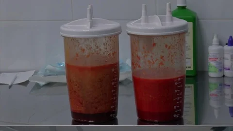 Partial removal of fat and mucous tissues. Fat liquid in the bottle from Stock Footage 83200128
