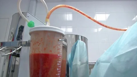 Partial removal of fat and mucous tissues. Fat liquid in the bottle from Stock Footage 83200195