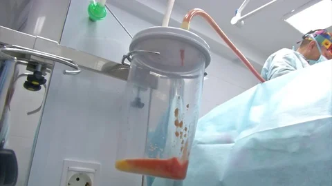 Partial removal of fat and mucous tissues. Fat liquid in the bottle from Video stock 83202682