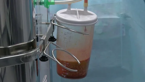 Partial removal of fat and mucous tissues. Fat liquid in the bottle from Stock Footage 83873719