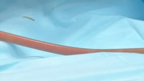 Partial removal of fat and mucous tissues. Fat liquid in the bottle from Stock Footage 83875988
