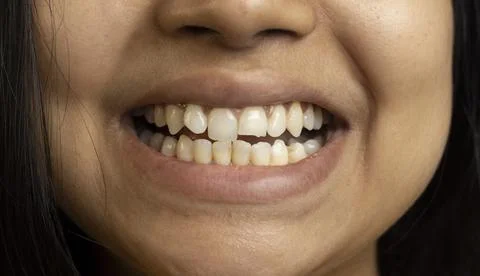 Partially broken tooth Stock Photos