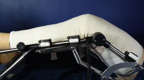 Passive gymnastick of the knee Video stock 62257310