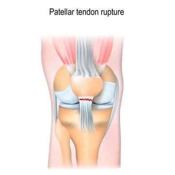 Patellar tendon rupture. Stock Illustration
