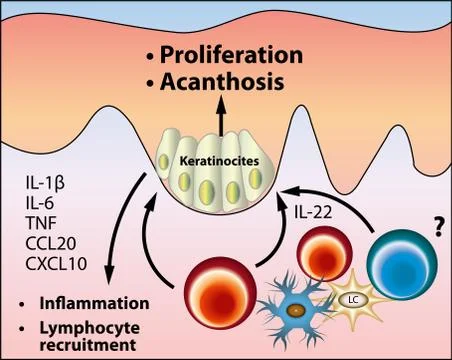 The pathogenesis of acanthosis nigricans vector scheme Stock Illustration
