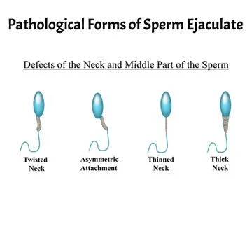 Pathological forms of sperm in the ejaculate. Male infertility Oligospermia Illustrazione stock