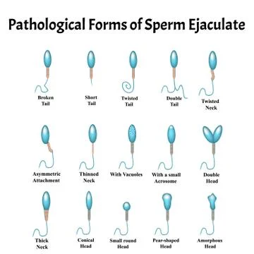 Pathological forms of sperm in the ejaculate. Male infertility Oligospermia Stock Illustration