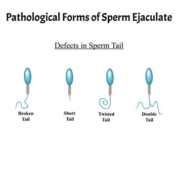 Pathological forms of sperm in the ejaculate. Male infertility Oligospermia Illustrazione stock