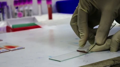 A pathologist gloved hand draws a blood smear on a glass slide Stock Footage 113383225