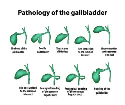 Pathology of the gallbladder. The bend of the gallbladder. Set. Vector Stock Illustration