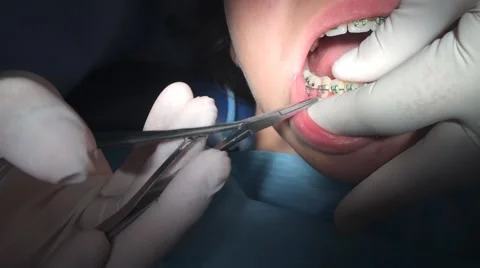 A patient with braces to shape the teeth Stock Footage 41574365