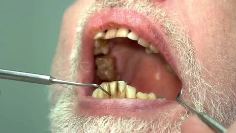 Patient of dentist, bad teeth. Video stock 74642443