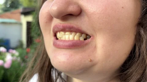 Patient with dislocated jaw and malocclusion, temporomandibular joint Stock Footage 346691360