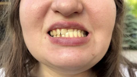 Patient with dislocated jaw and malocclusion, temporomandibular joint Stock Footage 346692633