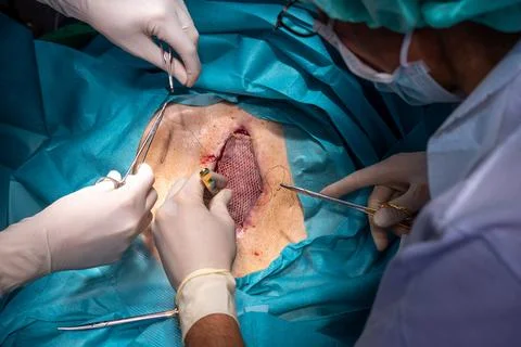 A patient has split skin transplanted on the abdomen to cover a wound Stock Photos