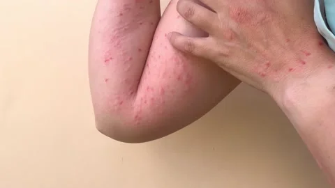 Patient with Monkey Pox. Stock Footage 197006705