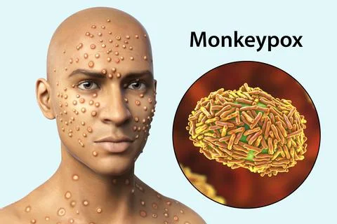 Patient with monkeypox and close-up view of monkeypox virus, 3D illustration Stock Illustration