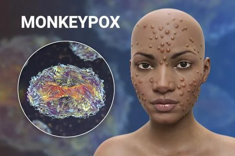 Patient with monkeypox and close-up view of monkeypox virus, 3D illustration Stock Illustration