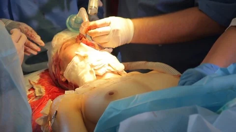 Patient on the operating table in the middle of surgery. Video stock 99220785