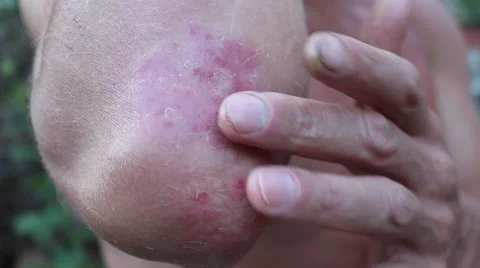 A patient with psoriasis Stock Footage